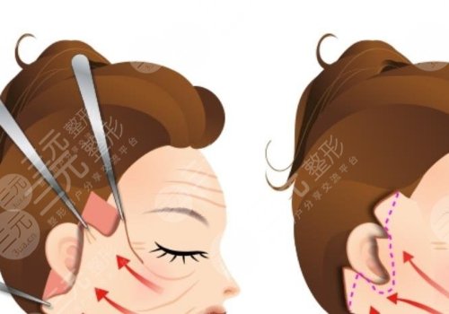 小拉皮和大拉皮的區(qū)別在哪里？