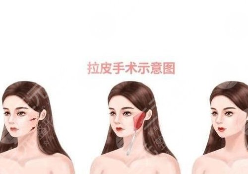 小拉皮和大拉皮的區(qū)別在哪里？