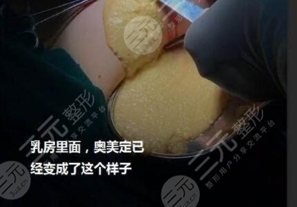 什么是清奧手術(shù)?