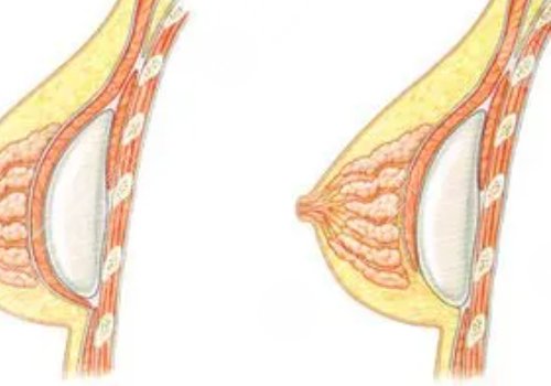 光面假體和毛面假體的優(yōu)缺點