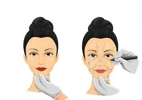 微調(diào)整形有風(fēng)險(xiǎn)嗎？