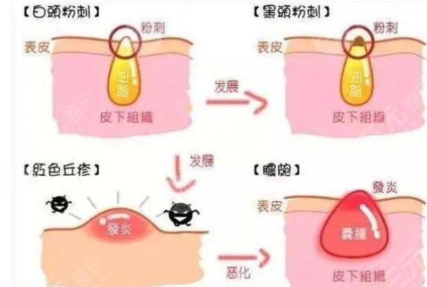 閉合性粉刺是怎么引起的