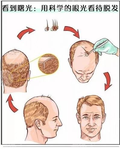 種一根頭發(fā)需要多少錢