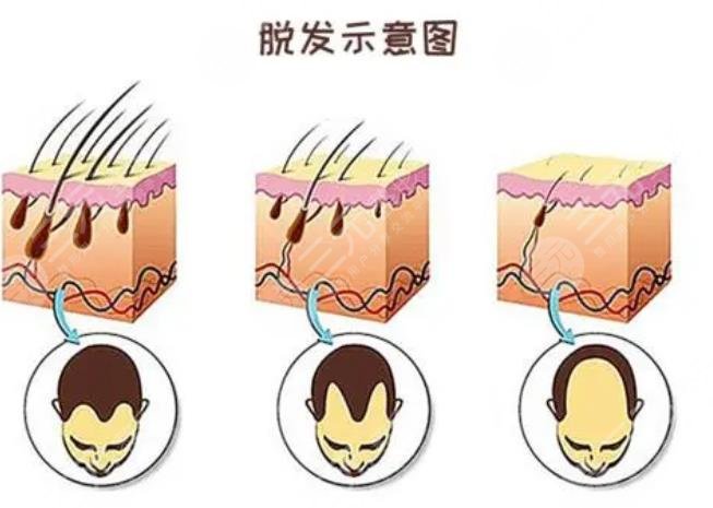 種一根頭發(fā)需要多少錢