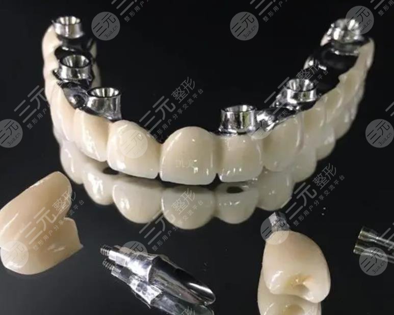 換牙齒需要多少錢一顆