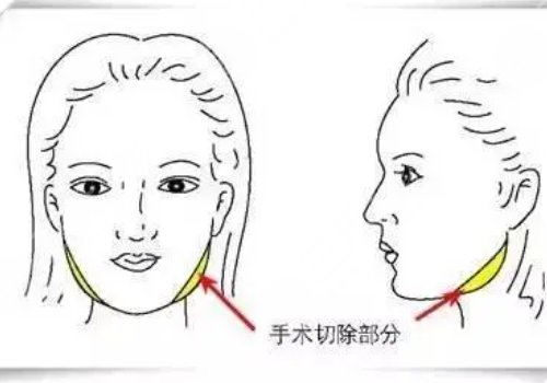 做臉部輪廓手術(shù)風(fēng)險高嗎？