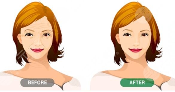 v美減齡面部提升效果好嗎?