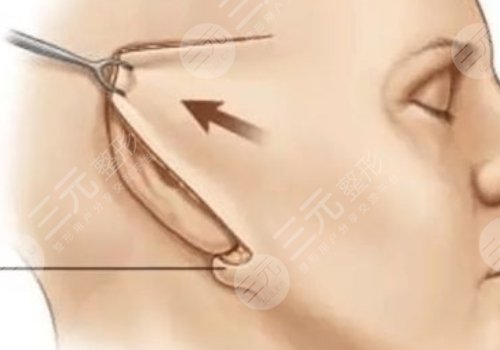 大拉皮手術(shù)15天是什么樣子？