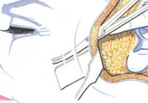 大拉皮手術(shù)15天是什么樣子？