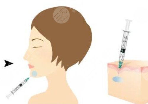 正規(guī)醫(yī)院注射除皺價格是多少？