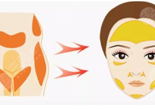 改良臉部輪廓做什么整形手術(shù)好？