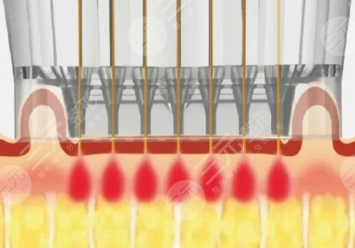 微針美塑和黃金微針的區(qū)別盤點(diǎn)