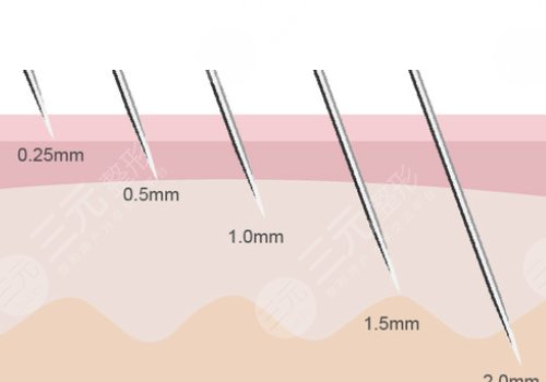 微針美塑和黃金微針的區(qū)別盤點(diǎn)