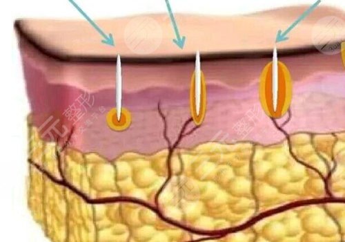 微針美塑和黃金微針的區(qū)別盤點(diǎn)