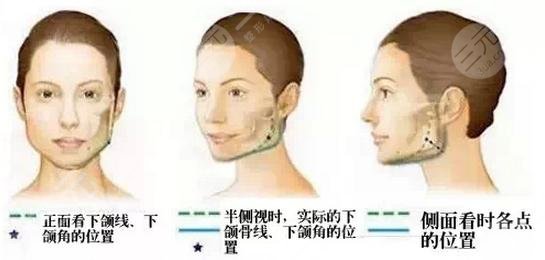 面部輪廓整形有什么后遺癥？