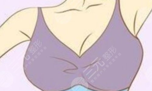 水滴形假體有光面的嗎？