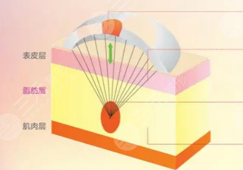 電波拉皮效果好嗎能維持多久？