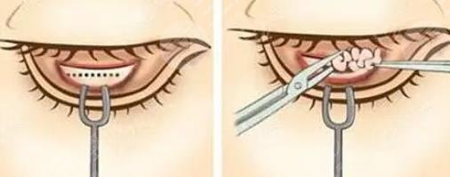 內(nèi)切眼袋手術(shù)后需要注意什么