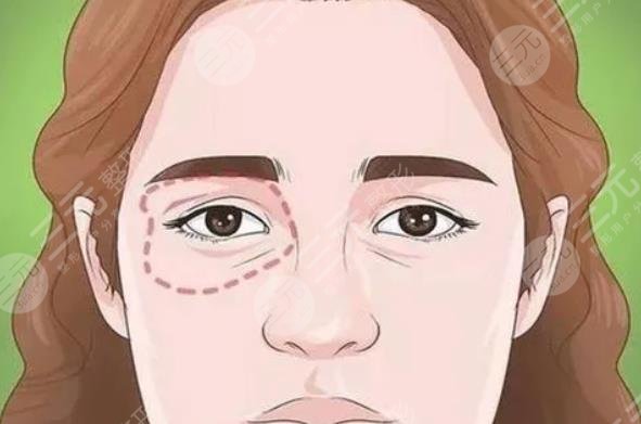 內(nèi)切眼袋手術(shù)后需要注意什么