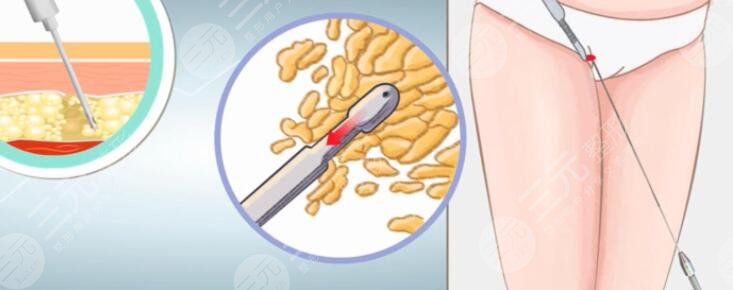 武漢亞太程曉林案例吸脂體驗，醫(yī)生資料信息|專業(yè)度怎么樣？