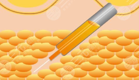 武漢亞太程曉林案例吸脂體驗