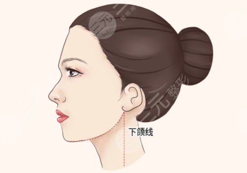 面部輪廓整形包括哪些種類(lèi)(項(xiàng)目)？