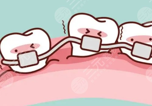牙齒矯正多少錢價(jià)格表2023