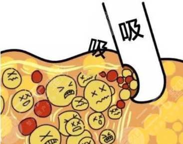 全身抽脂50斤的價格要5w？