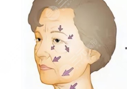 電波拉皮的危害和副作用有哪些?