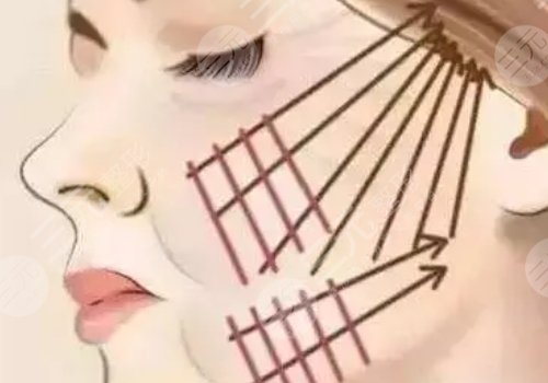 電波拉皮的危害和副作用有哪些?