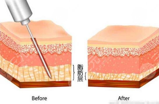 男士乳房肥大吸脂手術(shù)費用多少？價格標準公開！術(shù)前科普~