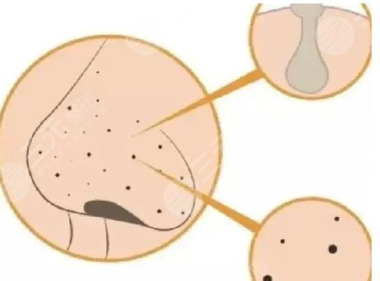 去黑頭什么產(chǎn)品好用一點(diǎn)？真心好用的去黑頭產(chǎn)品大合集！