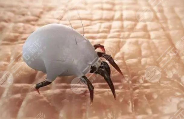 螨蟲感染皮膚的癥狀