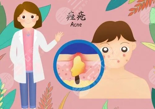 祛痘痘疤藥膏哪個(gè)好?
