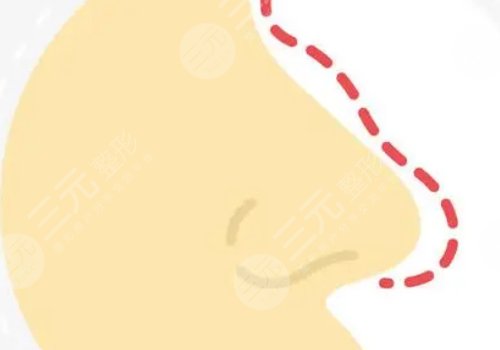 打玻尿酸隆鼻子有副作用嗎？