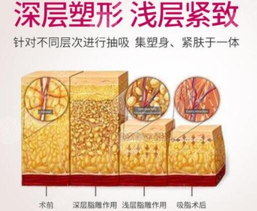 成都美萊王曾思吸脂怎么樣？醫(yī)生技術(shù)實(shí)力、案例測(cè)評(píng)公開(kāi)！