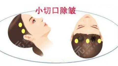 小切口除皺