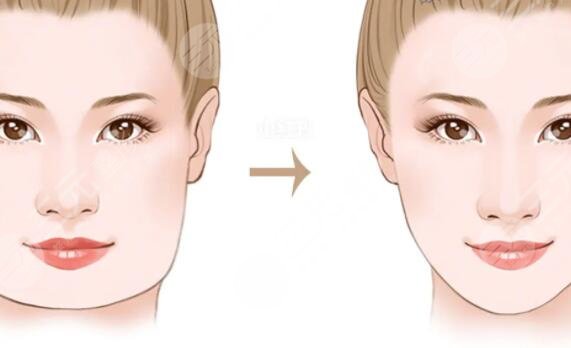 輪廓手術(shù)是怎么做的？