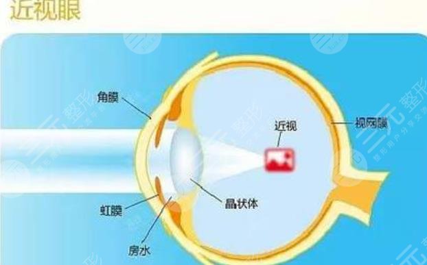 近視眼