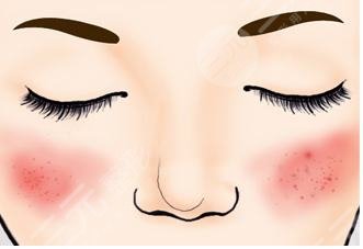 激光緩解臉部紅血絲怎么樣?