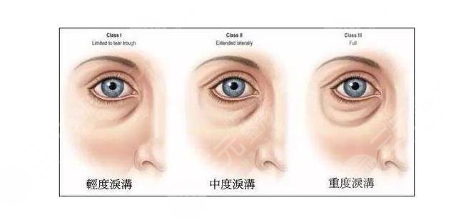 面部皺紋產(chǎn)生的原因