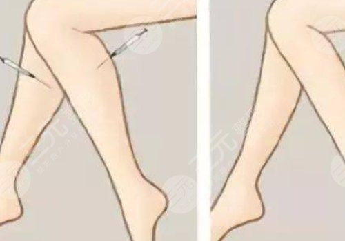 注射瘦腿會反彈嗎？
