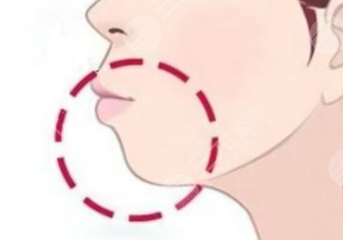 下顎線提升整形有什么做法？