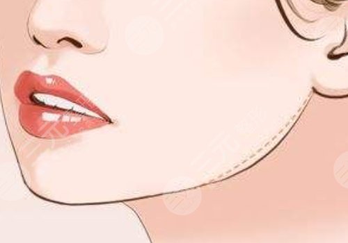 下顎線提升整形有什么做法？