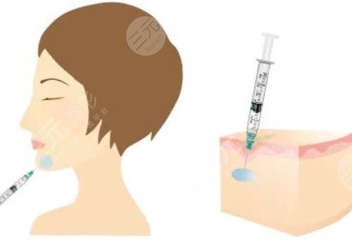 下顎線提升整形有什么做法？