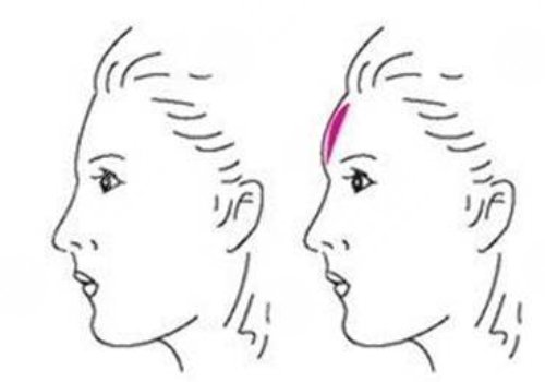 　　在日常的生活當(dāng)中，如果有的愛(ài)美人士想要通過(guò)一些好的方式來(lái)改良面部?jī)?nèi)輪廓以及外輪廓的話，可以通過(guò)吸脂以及注射一些好的物質(zhì)，還有手術(shù)的方式來(lái)進(jìn)行改良。  　　做面部?jī)?nèi)輪廓以及外輪廓，建議愛(ài)美人士在手術(shù)之前做好對(duì)于自己臉部方面的檢查，這樣的話容易根據(jù)自己實(shí)際情況來(lái)選擇合適的做這項(xiàng)手術(shù)的方式，也能夠幫助愛(ài)美人士有效的排出臉部當(dāng)中的一些脂肪，或者是改良愛(ài)美人士臉部當(dāng)做一些比較突出的骨頭。  　　達(dá)到一個(gè)比較理想的改良內(nèi)外輪廓的效果。建議愛(ài)美人士如果咬合肌比較大的話，可以通過(guò)注射一些玻尿酸以及其他的物質(zhì)來(lái)進(jìn)行緩解，這樣的話能夠起到一定的整形手術(shù)效果。