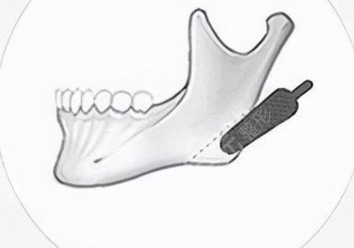 　　在日常的生活當(dāng)中，如果有的愛(ài)美人士想要通過(guò)一些好的方式來(lái)改良面部?jī)?nèi)輪廓以及外輪廓的話，可以通過(guò)吸脂以及注射一些好的物質(zhì)，還有手術(shù)的方式來(lái)進(jìn)行改良。  　　做面部?jī)?nèi)輪廓以及外輪廓，建議愛(ài)美人士在手術(shù)之前做好對(duì)于自己臉部方面的檢查，這樣的話容易根據(jù)自己實(shí)際情況來(lái)選擇合適的做這項(xiàng)手術(shù)的方式，也能夠幫助愛(ài)美人士有效的排出臉部當(dāng)中的一些脂肪，或者是改良愛(ài)美人士臉部當(dāng)做一些比較突出的骨頭。  　　達(dá)到一個(gè)比較理想的改良內(nèi)外輪廓的效果。建議愛(ài)美人士如果咬合肌比較大的話，可以通過(guò)注射一些玻尿酸以及其他的物質(zhì)來(lái)進(jìn)行緩解，這樣的話能夠起到一定的整形手術(shù)效果。