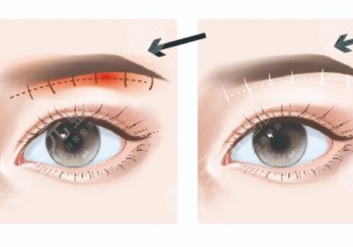 提眉術多久可以恢復自然？