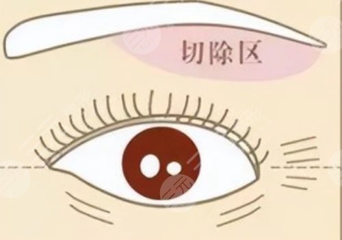 提眉術多久可以恢復自然？