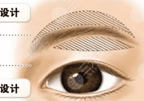 提眉術多久可以恢復自然？